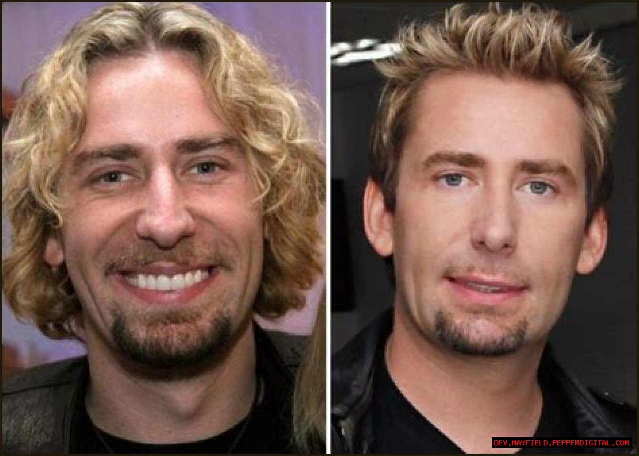 Unveiling The Truth: Did Chad Kroeger Have A Nose Job?